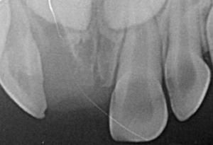 Trauma dentizione decidua